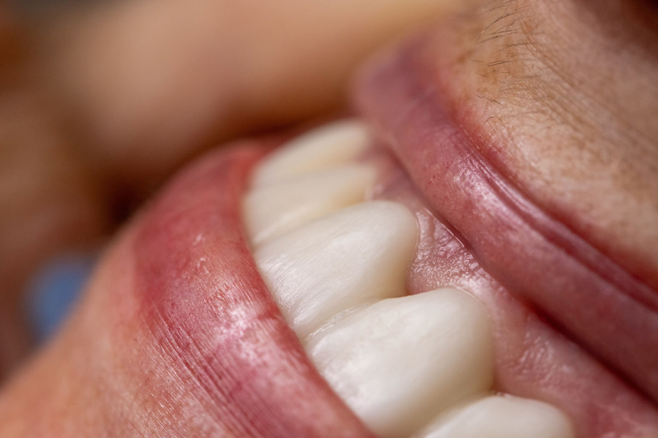 Dental Implant Surgery
